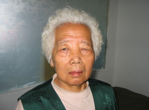 公主岭三叉神经痛康复患蔡阿姨