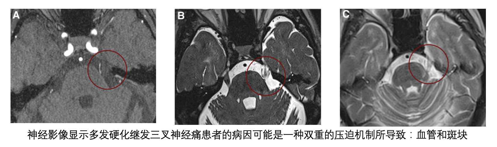 多发性硬化症的三叉神经痛:从临床到治疗选择