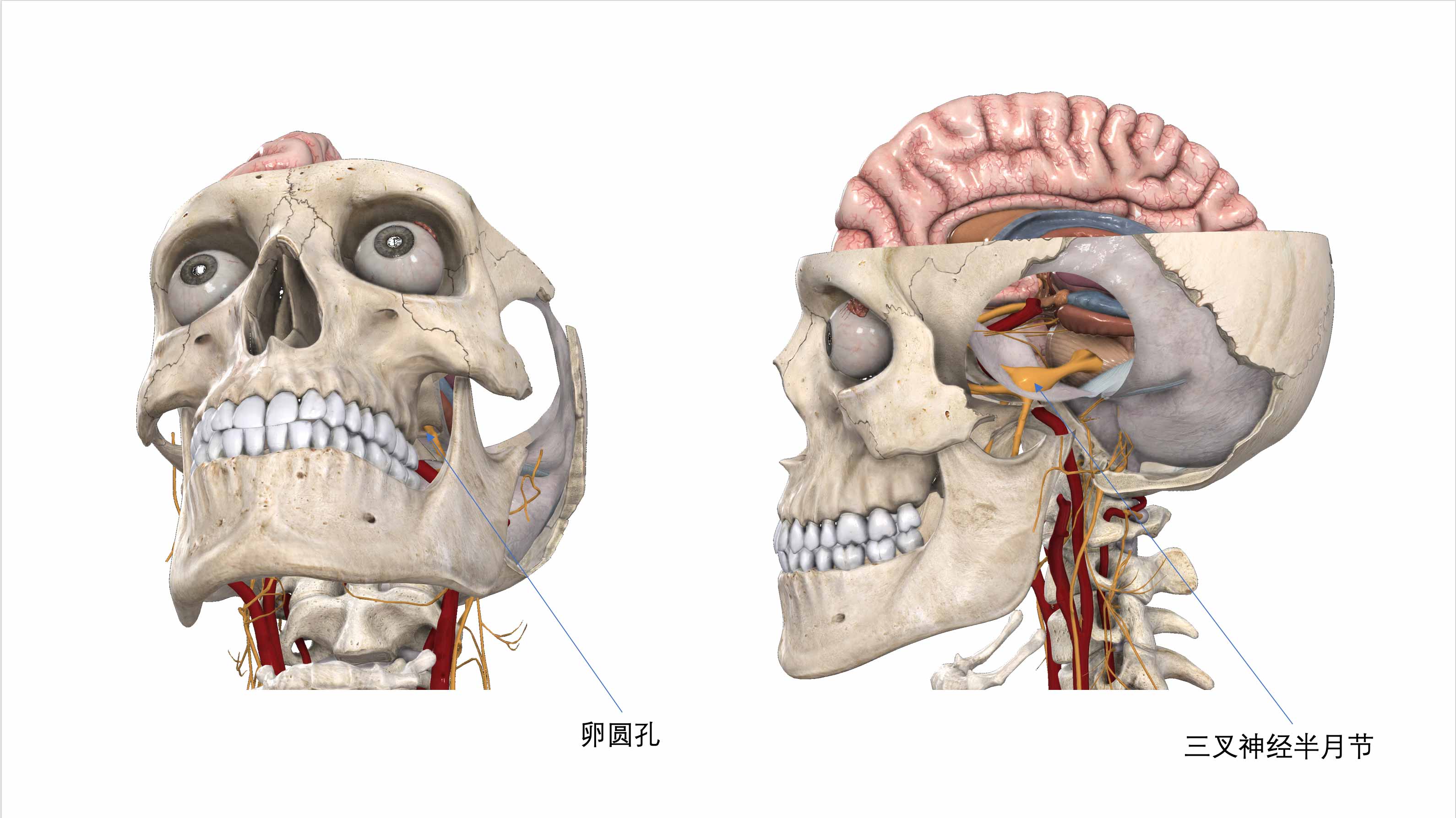 卵圆孔与三叉神经半月节的位置