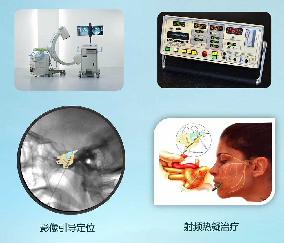 科普射频热凝术的工作原理