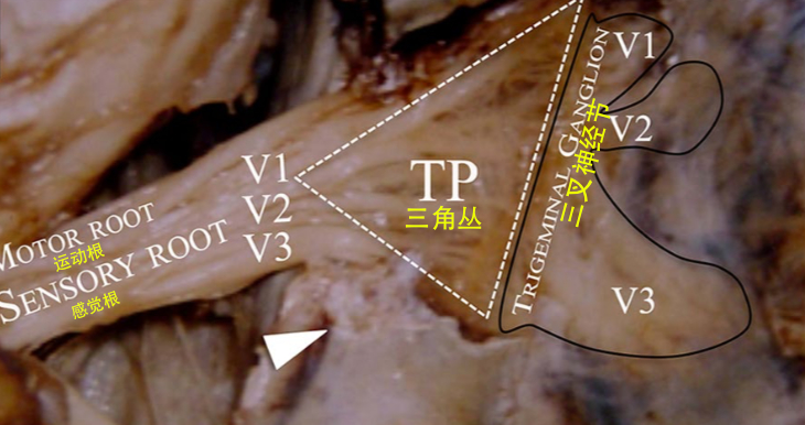 三叉神经三角丛：三叉神经痛射频热凝的准确部位